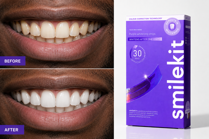SmileKit™ | Bandes Blanchissantes – Sourire Plus Blanc en 30 Minutes